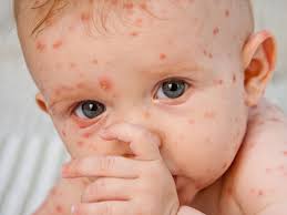 Baby with chicken pox 